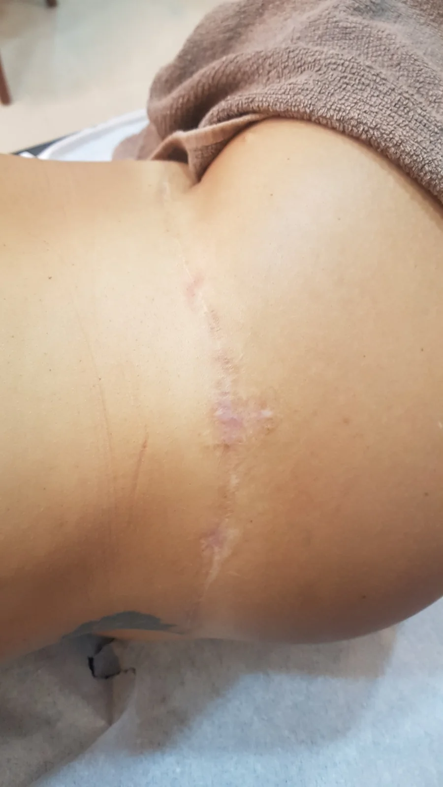 Depois do tratamento de cicatriz linear